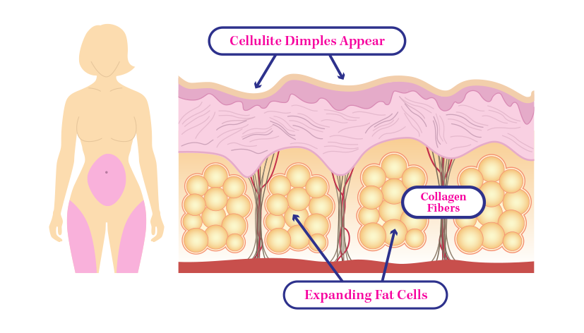 Illustration of the skin layer where cellulite forms